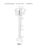 Intramedullary Canal Diameter Reducer diagram and image