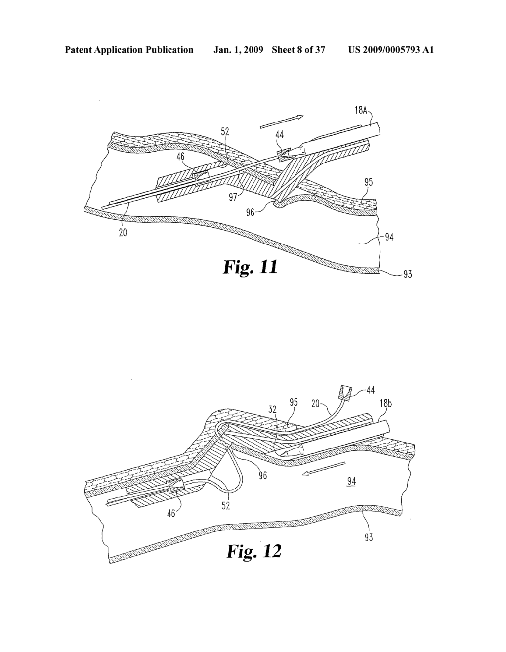 Vascular Suturing Device - diagram, schematic, and image 09