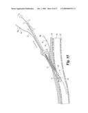 Vascular Suturing Device diagram and image