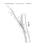 Vascular Suturing Device diagram and image