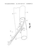 Vascular Suturing Device diagram and image