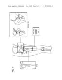 ENDOPROSTHESES FOR PERIPHERAL ARTERIES AND OTHER BODY VESSELS diagram and image