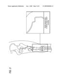 ENDOPROSTHESES FOR PERIPHERAL ARTERIES AND OTHER BODY VESSELS diagram and image