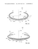 Post-Implant Accommodating Lens Modification diagram and image