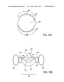 Post-Implant Accommodating Lens Modification diagram and image