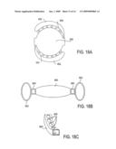 Post-Implant Accommodating Lens Modification diagram and image