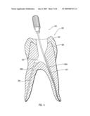 METHOD OF MANUFACTURING DENTAL INSTRUMENTS FROM SUPER-ELASTIC ALLOYS diagram and image