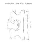 TITANIUM TREATMENT TO MINIMIZE FRETTING diagram and image