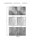 System and method for coronary digital subtraction angiography diagram and image