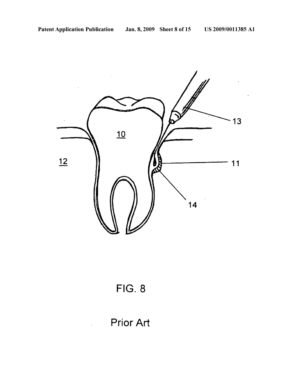 NON-INVASIVE METHOD FOR TREATING PERIODONTAL DISEASE - diagram, schematic, and image 09