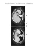 Methods of treating cancer with HDAC inhibitors diagram and image