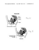 Apparatus for Posterior Pelvic Floor Repair diagram and image