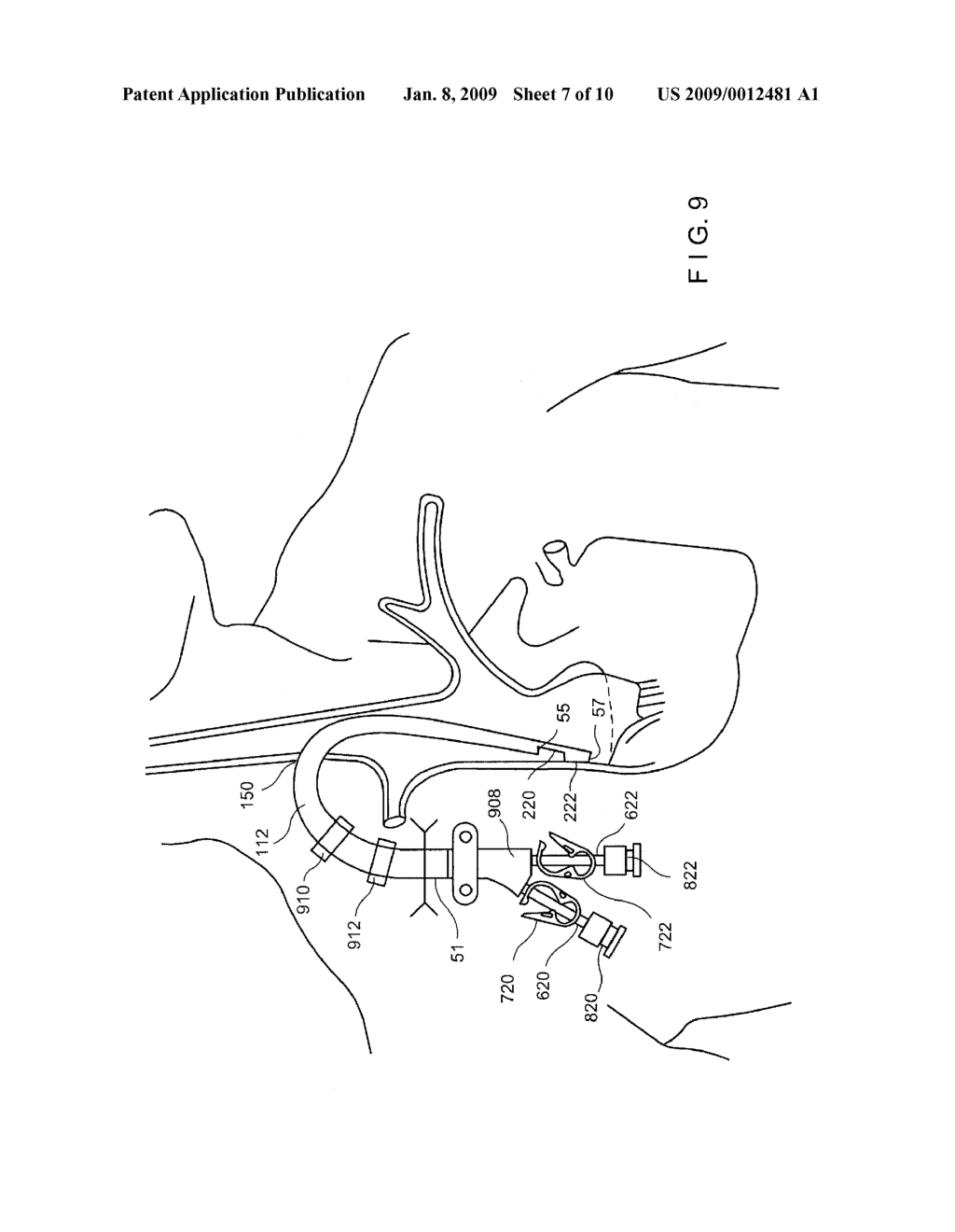 High Flow Rate Dialysis Catheters and Related Methods - diagram, schematic, and image 08