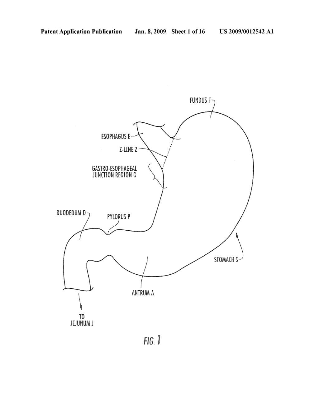 SATIATION DEVICES AND METHODS FOR CONTROLLING OBESITY - diagram, schematic, and image 02