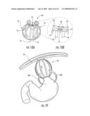 SATIATION DEVICES AND METHODS FOR CONTROLLING OBESITY diagram and image