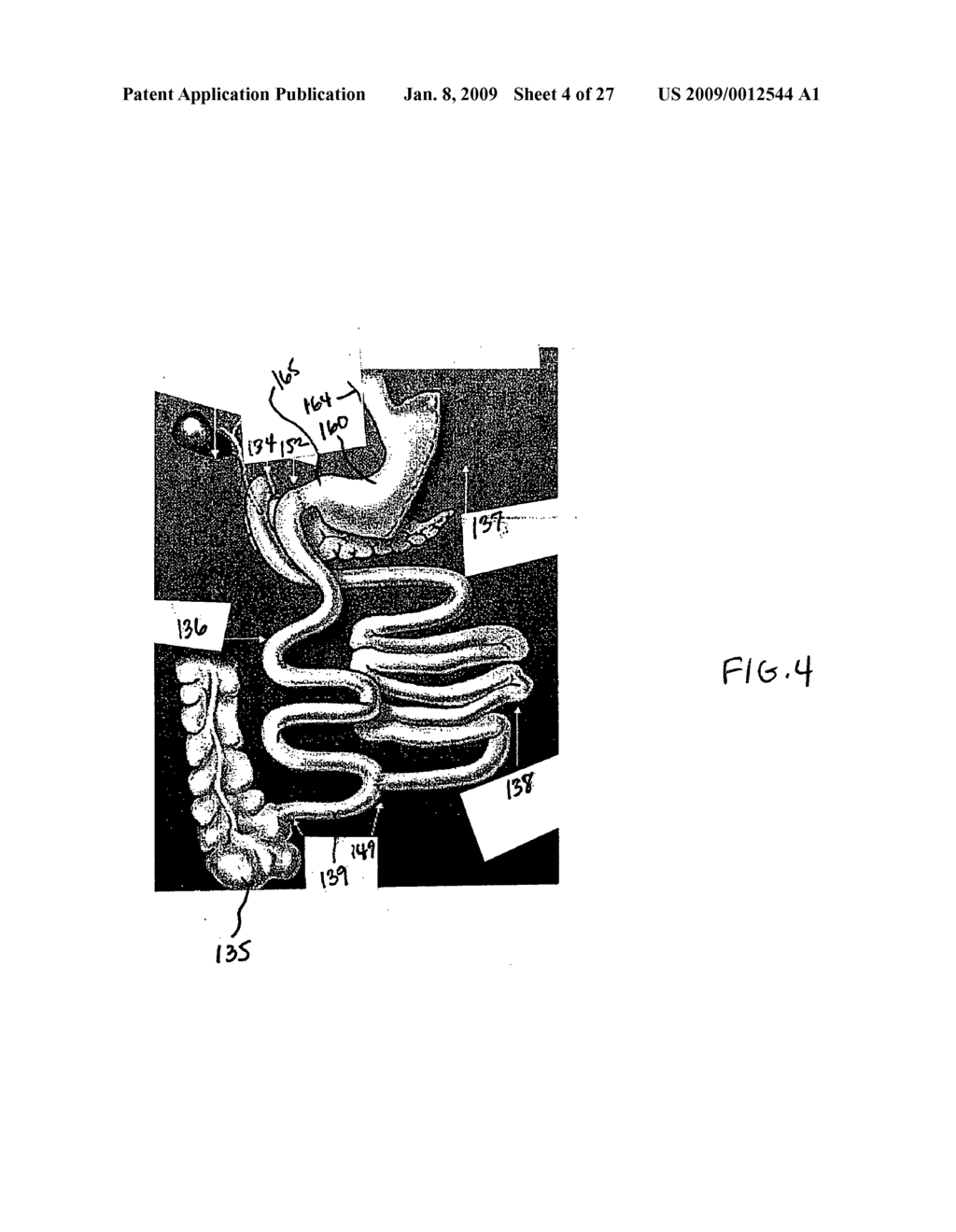 GASTROINTESTINAL BYPASS SLEEVE AS AN ADJUNCT TO BARIATRIC SURGERY - diagram, schematic, and image 05