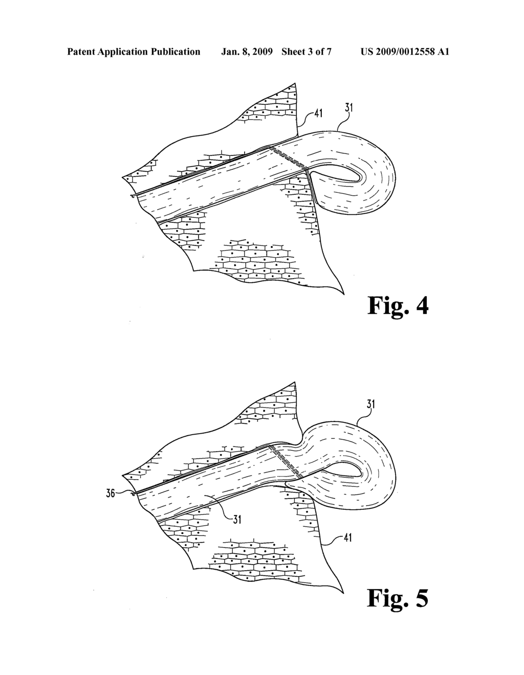 FISTULA GRAFTS HAVING A DEFLECTABLE GRAFT BODY PORTION - diagram, schematic, and image 04