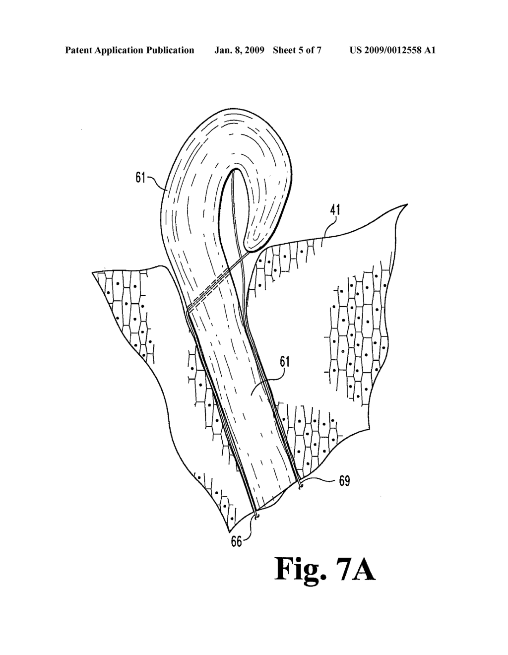 FISTULA GRAFTS HAVING A DEFLECTABLE GRAFT BODY PORTION - diagram, schematic, and image 06