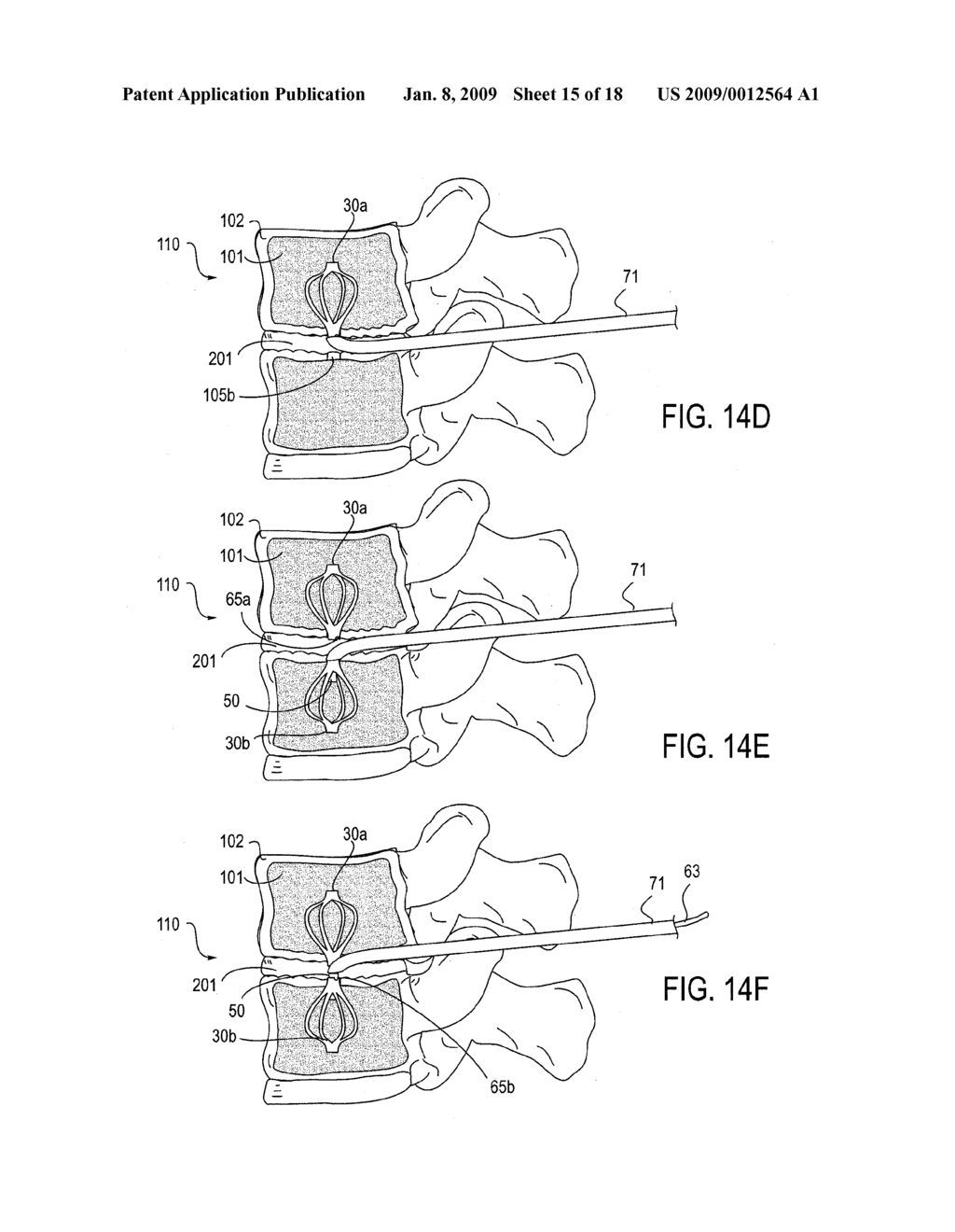 TRANSDISCAL INTERBODY FUSION DEVICE AND METHOD - diagram, schematic, and image 16