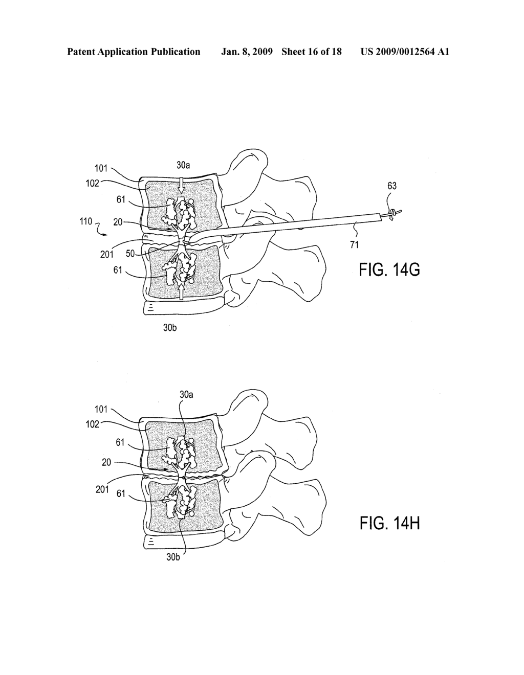 TRANSDISCAL INTERBODY FUSION DEVICE AND METHOD - diagram, schematic, and image 17