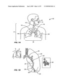 MINIMALLY INVASIVE LUNG VOLUME REDUCTION DEVICES, METHODS, AND SYSTEMS diagram and image