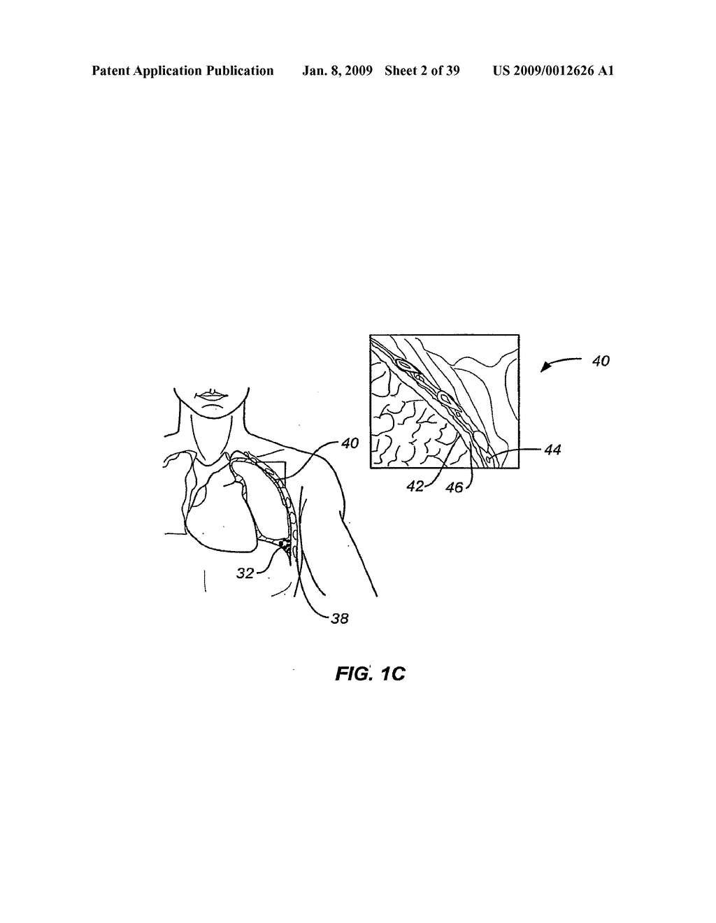 MINIMALLY INVASIVE LUNG VOLUME REDUCTION DEVICES, METHODS, AND SYSTEMS - diagram, schematic, and image 03