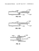 MINIMALLY INVASIVE LUNG VOLUME REDUCTION DEVICES, METHODS, AND SYSTEMS diagram and image