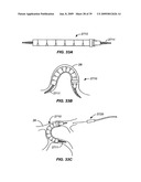 MINIMALLY INVASIVE LUNG VOLUME REDUCTION DEVICES, METHODS, AND SYSTEMS diagram and image