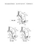 MINIMALLY INVASIVE LUNG VOLUME REDUCTION DEVICES, METHODS, AND SYSTEMS diagram and image