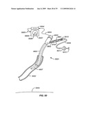 MINIMALLY INVASIVE LUNG VOLUME REDUCTION DEVICES, METHODS, AND SYSTEMS diagram and image