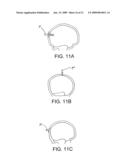 RADIOLUCENT FASTENING DEVICES FOR SECURING A PART OF A BODY DURING A MEDICAL PROCEDURE diagram and image