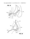 DEVICES AND METHODS FOR DELIVERING ACTIVE AGENTS TO THE OSTEOMEATAL COMPLEX diagram and image