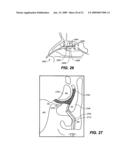 DEVICES AND METHODS FOR DELIVERING ACTIVE AGENTS TO THE OSTEOMEATAL COMPLEX diagram and image