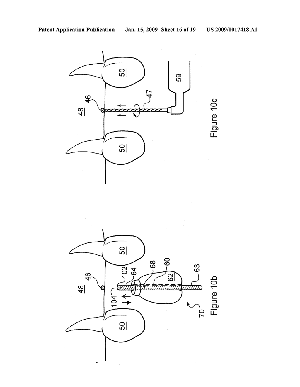 DENTAL IMPLANT SURGICAL GUIDE - diagram, schematic, and image 17