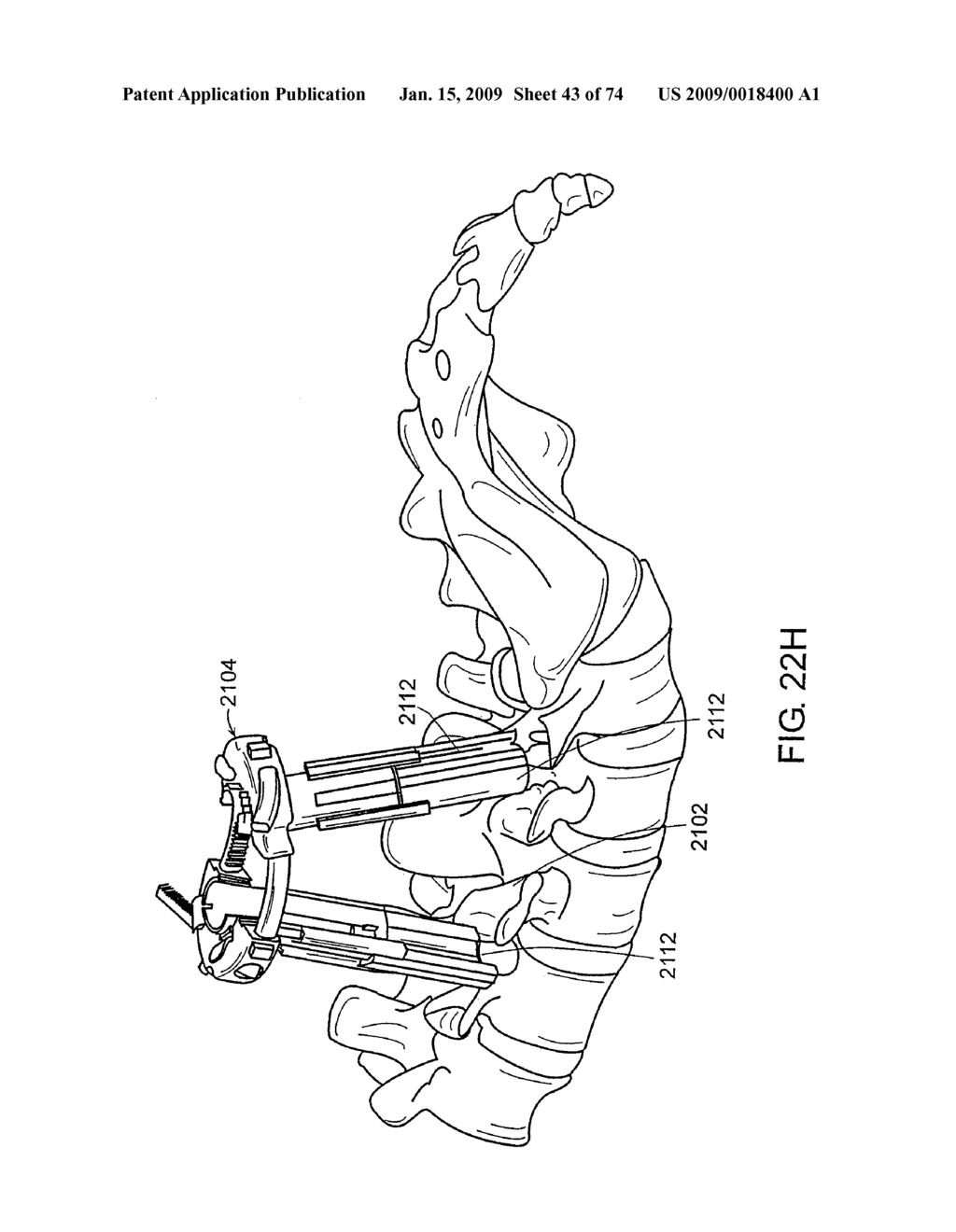 SURGICAL RETRACTOR SYSTEMS AND ILLUMINATED CANNULAE - diagram, schematic, and image 44