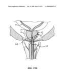 MULTI-ACTUATING TRIGGER ANCHOR DELIVERY SYSTEM diagram and image