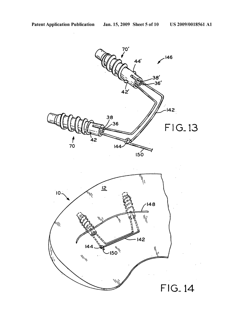 Medical device for repair of tissue and method for implantation and fixation - diagram, schematic, and image 06