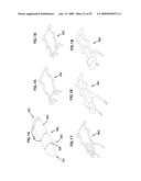 Wound closure product diagram and image