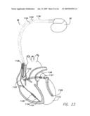 SYSTEMS AND METHODS FOR EMPLOYING MULTIPLE FILTERS TO DETECT T-WAVE OVERSENSING AND TO IMPROVE TACHYARRHYTHMIA DETECTION WITHIN AN IMPLANTABLE MEDICAL DEVICE diagram and image