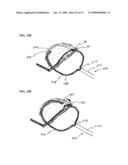 Methods And Systems For Performing Submucosal Medical Procedures diagram and image