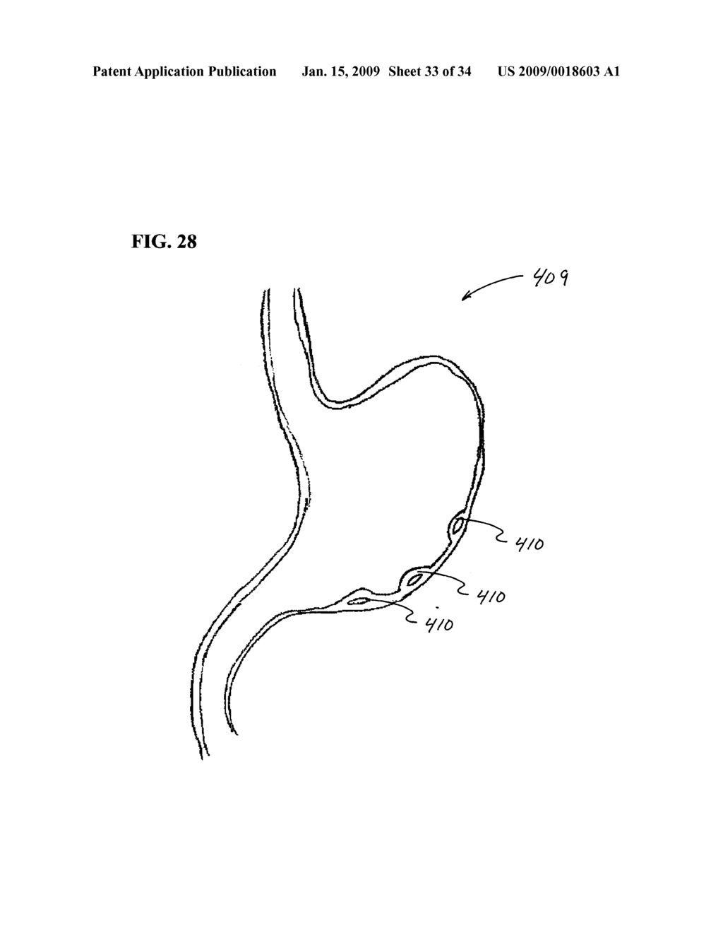 Methods and Systems for Submucosal Implantation of a Device for Diagnosis and Treatment of a Body - diagram, schematic, and image 34