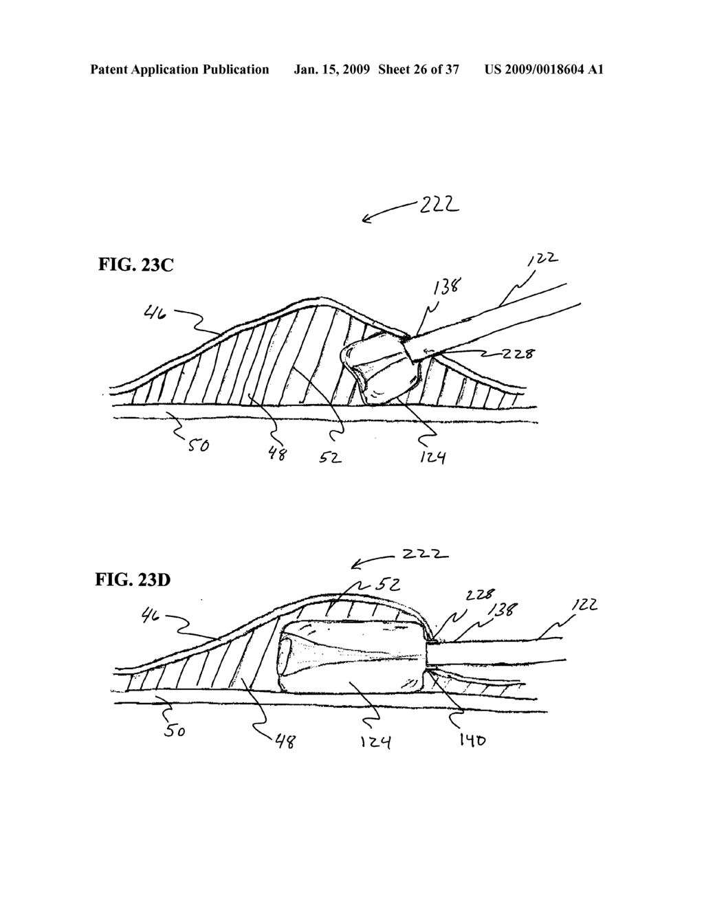 Methods And Systems for Submucosal Implantation of a Device For Diagnosis and Treatment with a Therapeutic Agent - diagram, schematic, and image 27