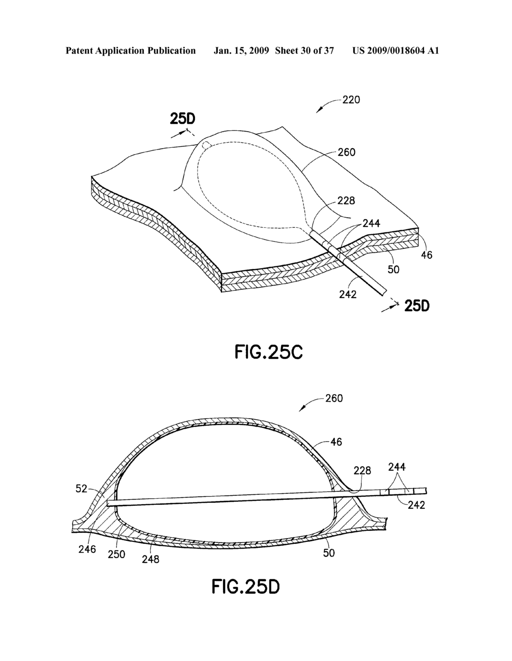 Methods And Systems for Submucosal Implantation of a Device For Diagnosis and Treatment with a Therapeutic Agent - diagram, schematic, and image 31