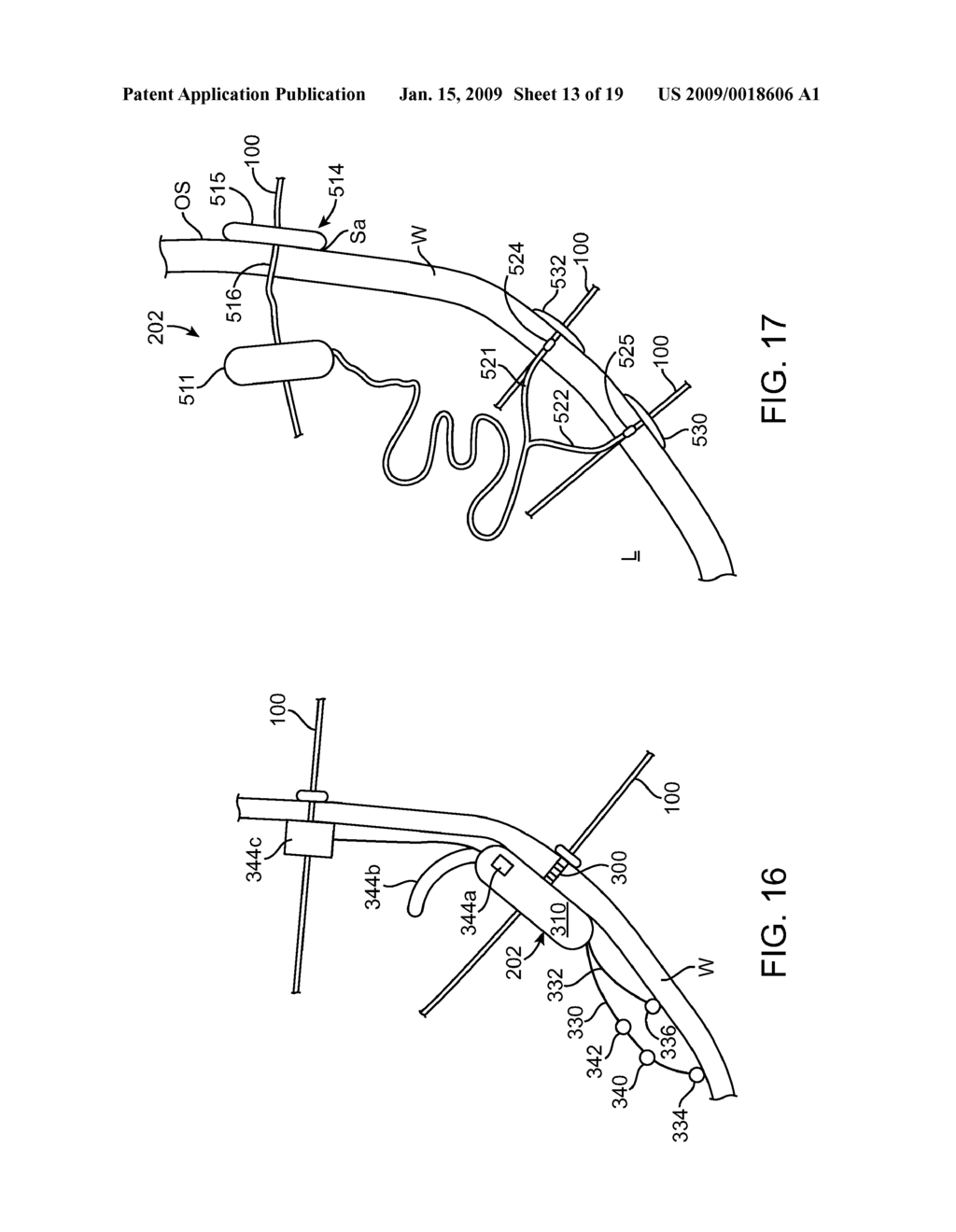 Methods and Devices for Stimulation of an Organ with the Use of a Transectionally Placed Guide Wire - diagram, schematic, and image 14