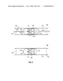 Methods and apparatus for rapid endovascular vessel occlusion and blood flow interruption diagram and image