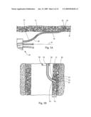 Minimally invasive medical device and method for delivery of therapeutic or diagnostic agents into a vessel wall diagram and image