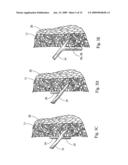 Minimally invasive medical device and method for delivery of therapeutic or diagnostic agents into a vessel wall diagram and image