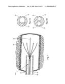 Minimally invasive medical device and method for delivery of therapeutic or diagnostic agents into a vessel wall diagram and image