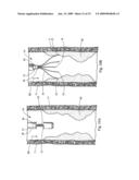 Minimally invasive medical device and method for delivery of therapeutic or diagnostic agents into a vessel wall diagram and image