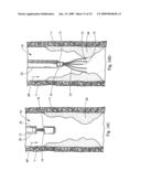 Minimally invasive medical device and method for delivery of therapeutic or diagnostic agents into a vessel wall diagram and image